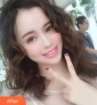长效玻尿酸
