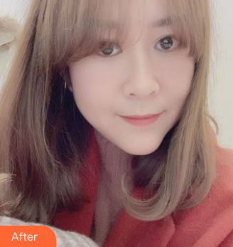 长效玻尿酸