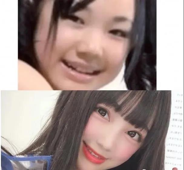 去眼袋手术