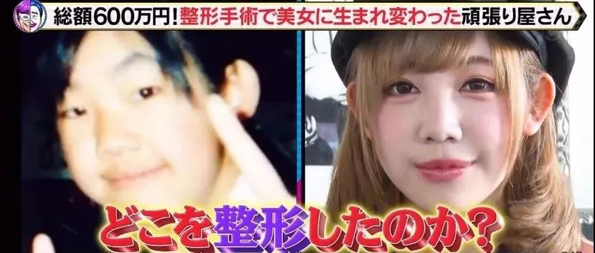 去眼袋手术