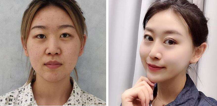 双眼皮手术