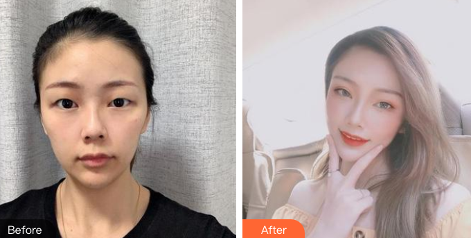 双眼皮手术