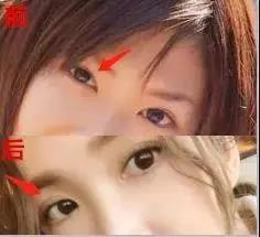 双眼皮手术