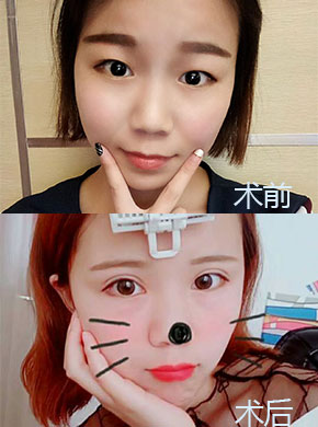 双眼皮手术