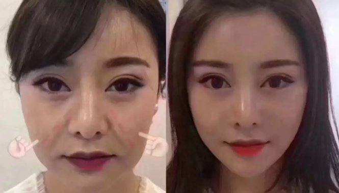 面部提升术