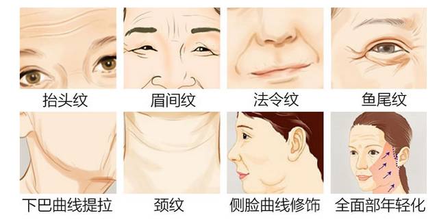 面部提升术
