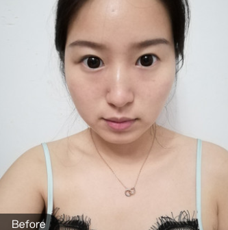 双眼皮手术