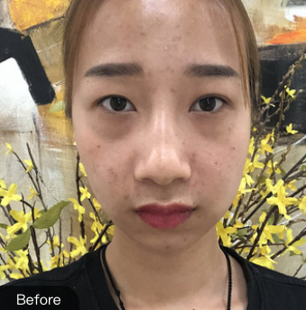 去眼袋手术