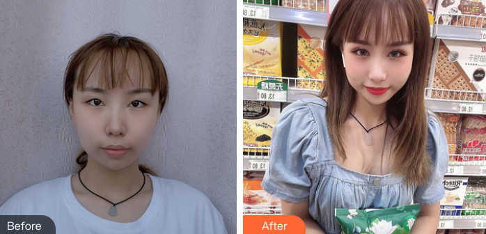 双眼皮手术