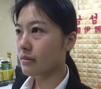 去眼袋手术