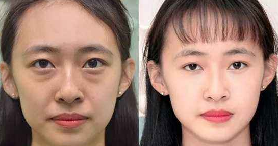 去眼袋手术
