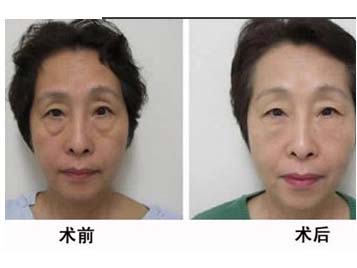 去眼袋手术