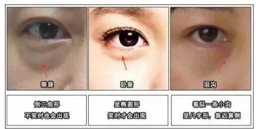 去眼袋手术