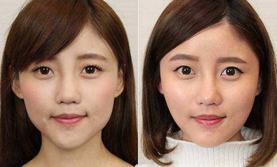 超声波瘦脸