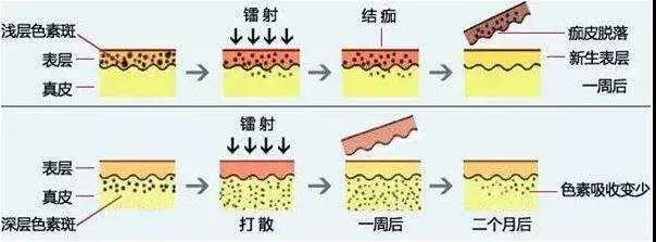超皮秒祛斑