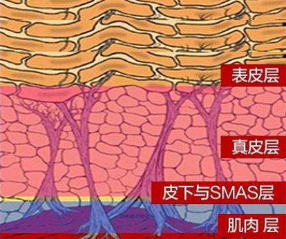 面部提升术