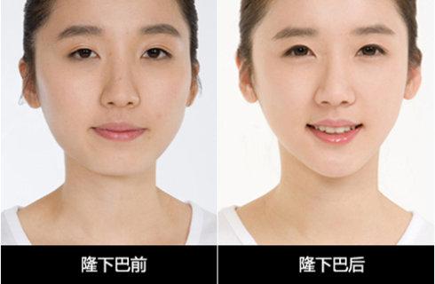 长效玻尿酸