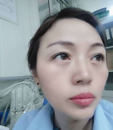去眼袋手术