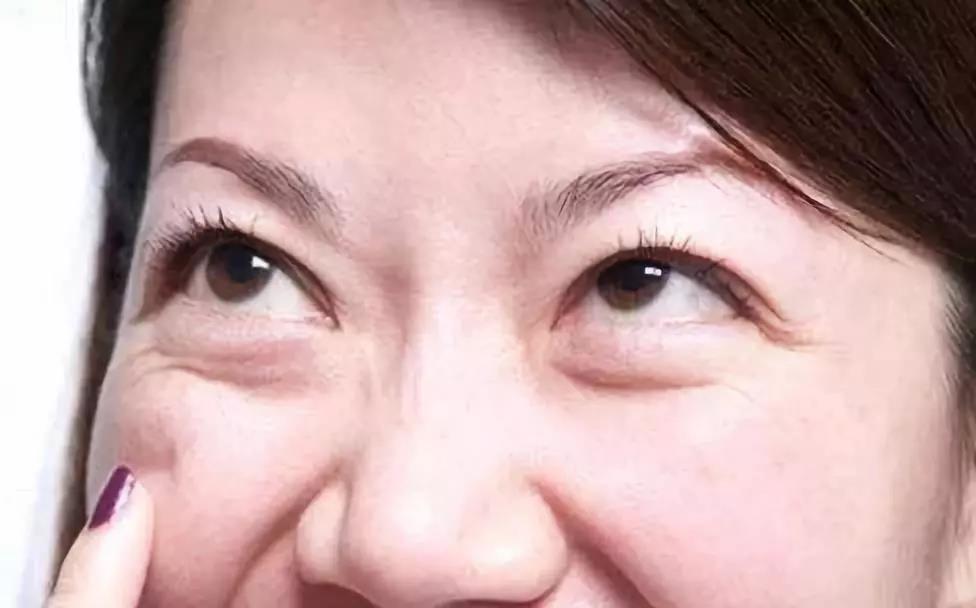 去眼袋手术