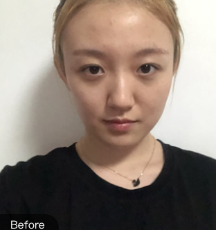 去眼袋手术