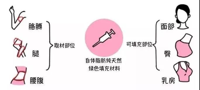 自体脂肪填充术