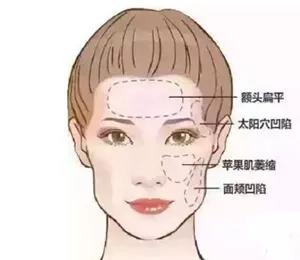 自体脂肪填充术