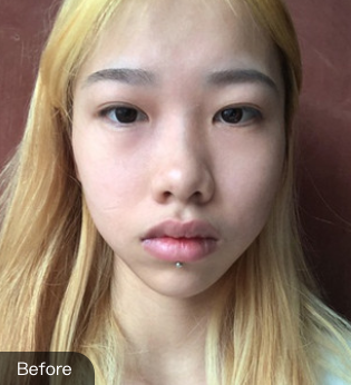自体脂肪填充术