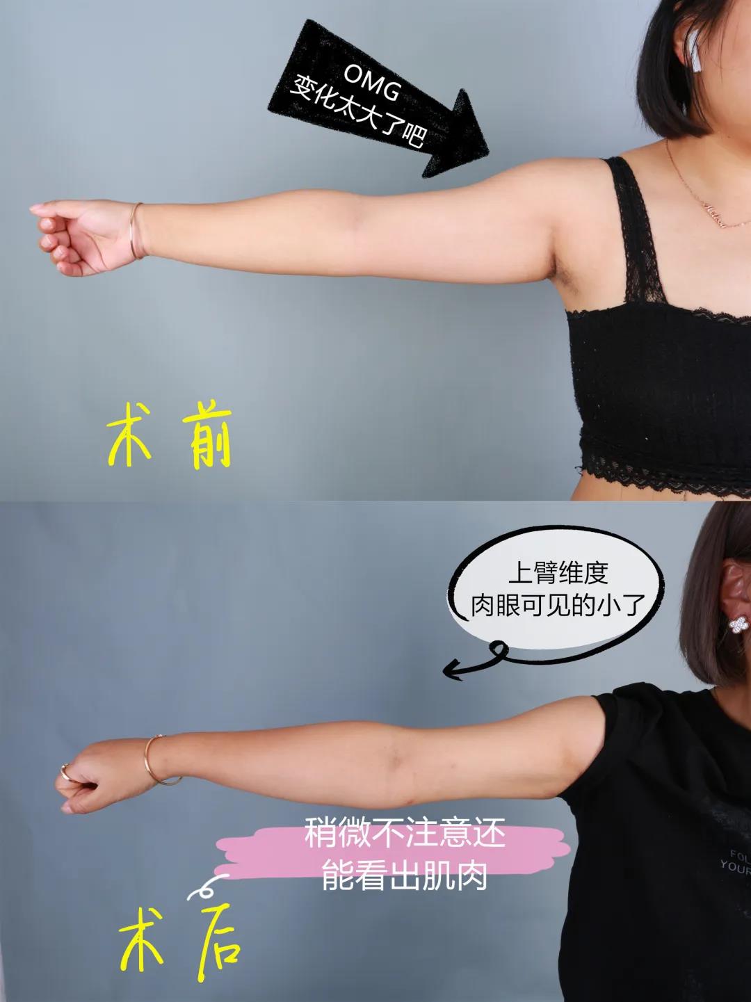超声波减肥