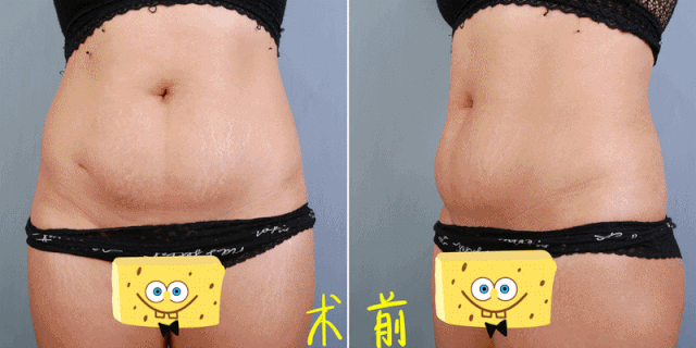 超声波减肥