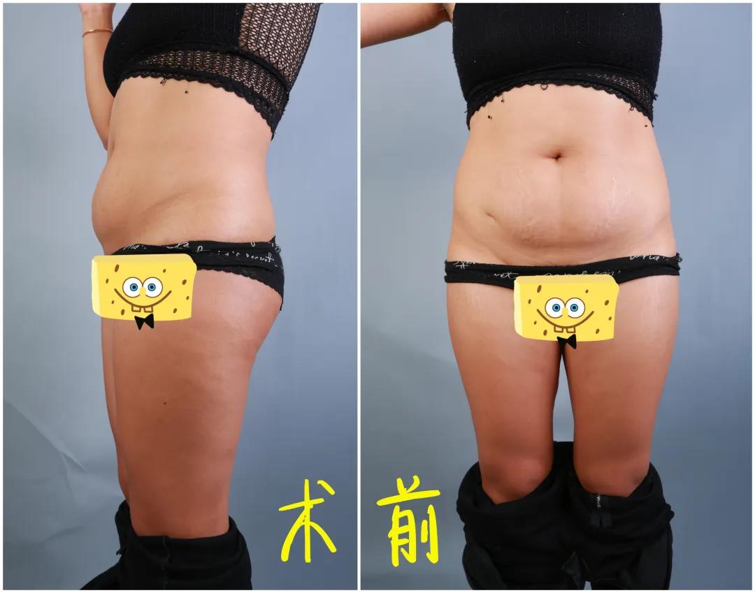 超声波减肥