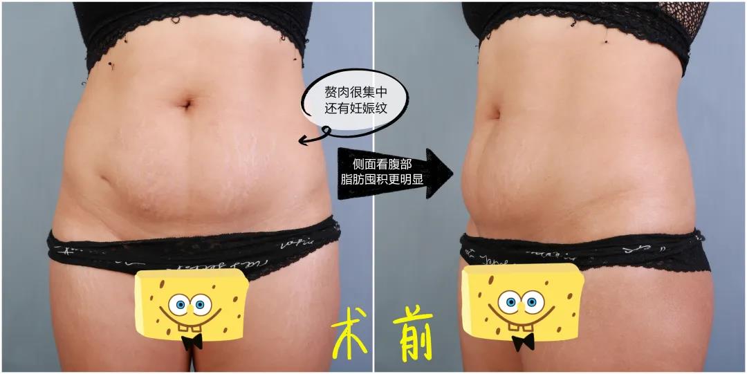 超声波减肥