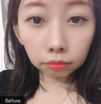 长效玻尿酸