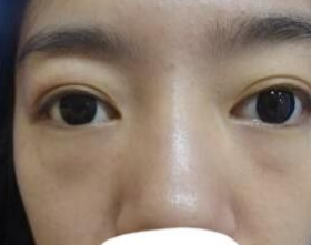 去眼袋手术