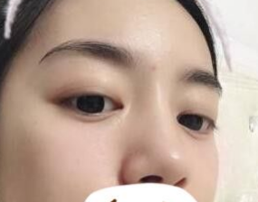 去眼袋手术
