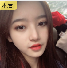 双眼皮手术
