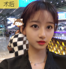 双眼皮手术