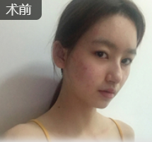 双眼皮手术