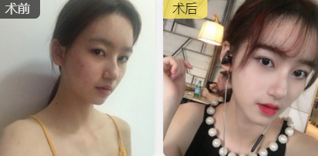 双眼皮手术