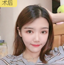 双眼皮手术