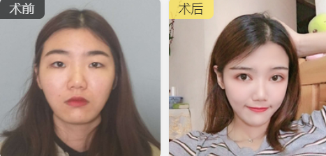 双眼皮手术