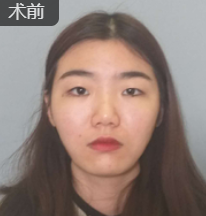 双眼皮手术