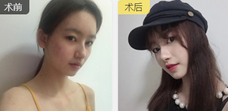 双眼皮手术