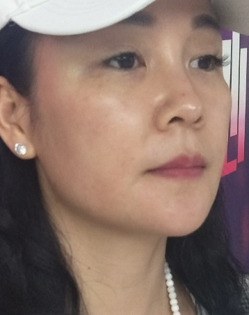 去眼袋手术