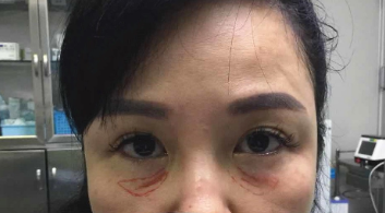 去眼袋手术