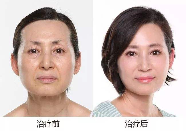 面部提升术