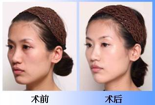 面部提升术