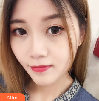 双眼皮手术