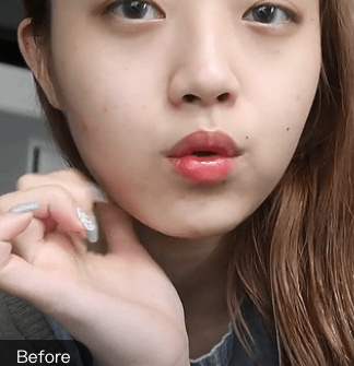 长效玻尿酸