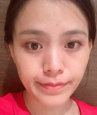 去眼袋手术