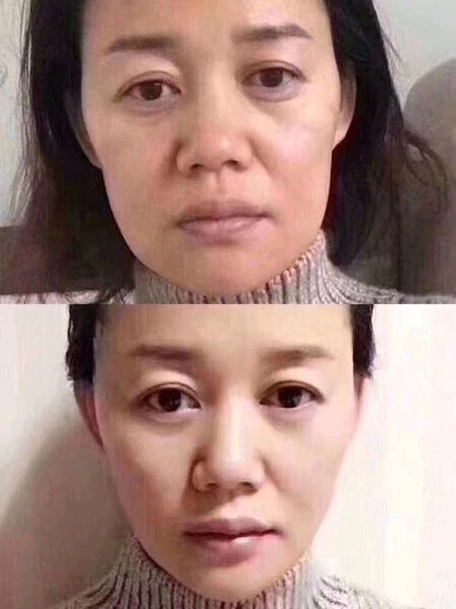面部提升术